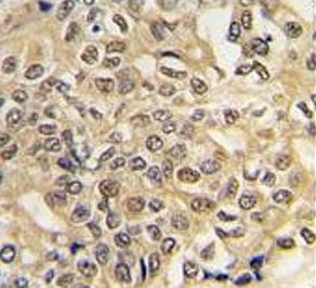 IHC testing of FFPE human hepatocellular carcinoma tissue with Ubiquitin-like modifier-activating en