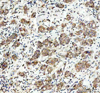 IHC staining of FFPE human breast cancer tissue with MAP3K1 antibody. HIER: boil tissue sections in 