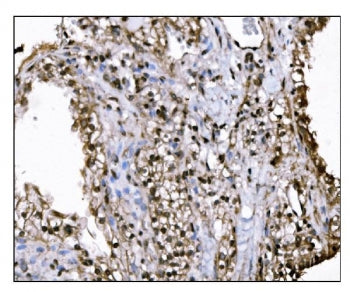 IHC staining of FFPE human renal clear cell carcinoma tissue with KMT1B antibody. HIER: boil tissue 