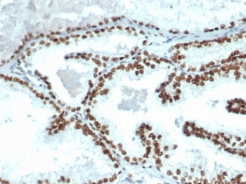 IHC staining of FFPE human prostate carcinoma tissue with recombinant Androgen Receptor antibody (cl