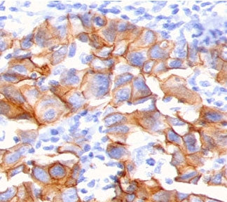 IHC staining of FFPE human breast carcinoma with NRG1 antibody (clone HRGA1-1). HIER: boil tissue se