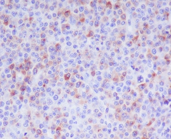 IHC staining of FFPE human T-cell lymphoma tissue with Granzyme B antibody. HIER: boil tissue sectio