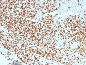 IHC testing of FFPE Ewings sarcoma with NKX2.2 antibody (clone NX2/1523). HIER: steam sections in pH