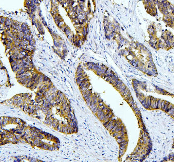 IHC staining of FFPE human colon cancer with Tafazzin antibody. HIER: boil tissue sections in pH8 ED