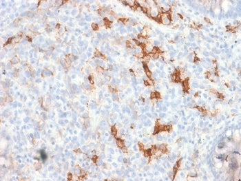 IHC testing of FFPE human melanoma tissue with recombinant p75NTR antibody. Required HIER: boil tiss