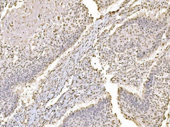 IHC staining of FFPE human laryngeal squamous cell carcinoma tissue with c-Jun antibody. HIER: boil 