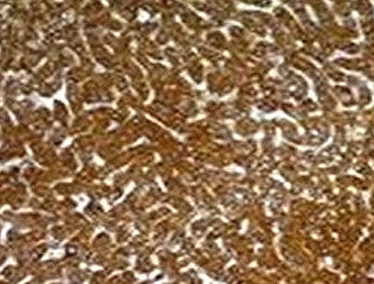 IHC: Formalin-fixed, paraffin-embedded human hepatocellular carcinoma stained with Hepatocyte antibo