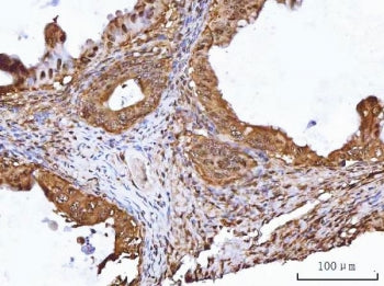 IHC staining of FFPE human ovarian cancer tissue with TIP49A antibody. HIER: boil tissue sections in
