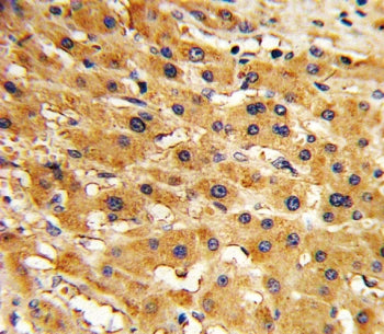 IHC testing of FFPE human hepatocellular carcinoma tissue with Adenine phosphoribosyltransferase ant