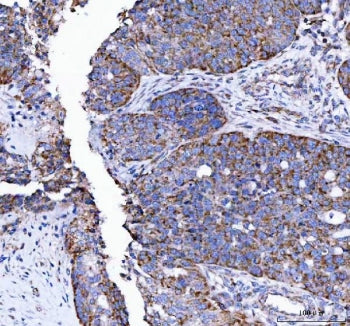 IHC staining of FFPE human ovarian cancer tissue with LRRN4 antibody. HIER: boil tissue sections in 