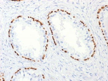 IHC testing of FFPE human prostate carcinoma with p63 antibody (clone TP63/2427). HIER: boil tissue 