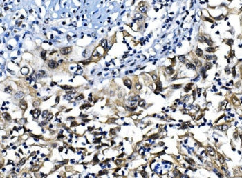 IHC staining of FFPE human lung cancer with IRF-1 antibody. HIER: boil tissue sections in pH8 EDTA f