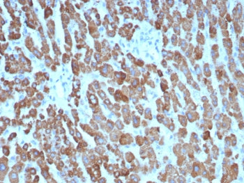IHC staining of FFPE human hepatocellular carcinoma tissue with CPS1 antibody (clone CPS1/8416). HIE