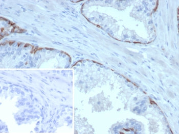 IHC staining of FFPE human prostate carcinoma tissue with Cytokeratin 14 antibody (clone KRT14/6962)
