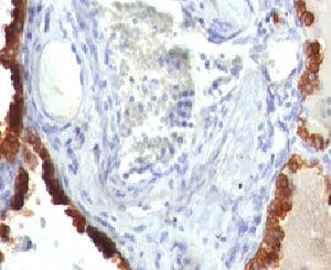 IHC: Formalin-fixed, paraffin-embedded human lung carcinoma stained with Cytokeratin 7 antibody (clo