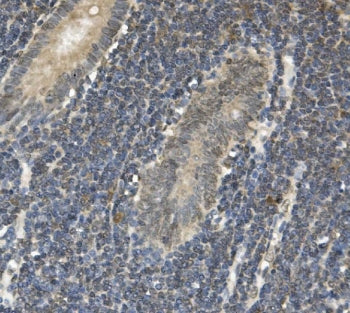 IHC staining of FFPE human rectal cancer with EAPP antibody. HIER: boil tissue sections in pH8 EDTA 