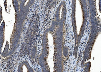 IHC staining of FFPE human rectal cancer with CASP7 antibody. HIER: boil tissue sections in pH8 EDTA