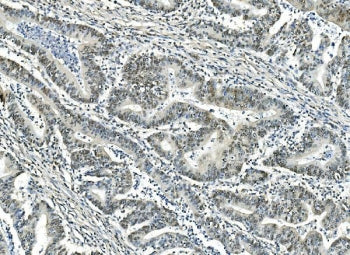 IHC staining of FFPE human rectal cancer with ATF1 antibody. HIER: boil tissue sections in pH8 EDTA 