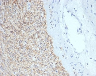 IHC staining of FFPE human gastrointestinal stromal tumor (GIST) with CD117 / SCFR antibody (clone C