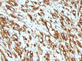 IHC: Formalin-fixed, paraffin-embedded human rhabdomyosarcoma stained with pan Muscle Actin antibody