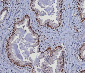 IHC staining of FFPE human prostate tissue with MGMT antibody (clone MGMT/8364R). HIER: boil tissue 