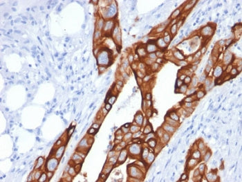 IHC testing of human colon carcinoma with Cytokeratin 20 antibody (clone KRT20/1991). Required HIER: