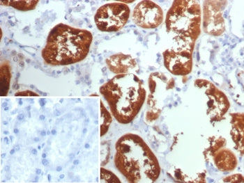 IHC staining of FFPE human kidney cancer with TPH1 antibody (clone TPH1/7661). Inset: PBS used in pl