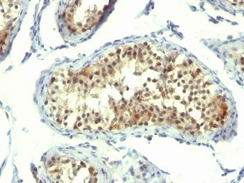 Formalin-fixed, paraffin-embedded human testicular carcinoma stained with Thymidylate Synthase antib