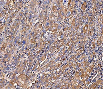 IHC staining of FFPE human gall bladder adenosquamous carcinoma tissue with SCRN1 antibody. HIER: bo