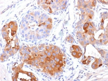 IHC testing of FFPE human breast carcinoma with PIP antibody (clone PIP/1571). Required HIER: boil t