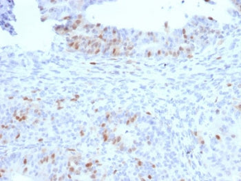 IHC staining of FFPE human colon carcinoma with RAD51 antibody. HIER: boil tissue sections in pH 9 1