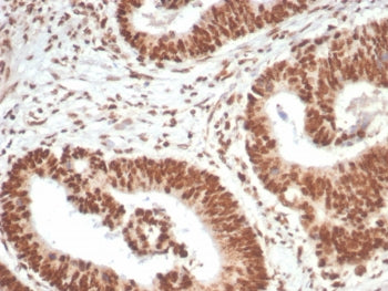 IHC staining of FFPE human colon carcinoma tissue with WT1-associated protein antibody (clone PCRP-W