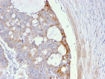 IHC staining of FFPE human colon carcinoma with Thomsen-Friedenreich Antigen antibody (clone A63-C/A