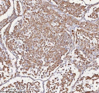 IHC staining of FFPE human lung adenocarcinoma tissue with SLC6A20 antibody. HIER: boil tissue secti