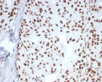 IHC staining of FFPE human breast carcinoma tissue with HSPA1B antibody (clone HSPA1B/7624). HIER: b