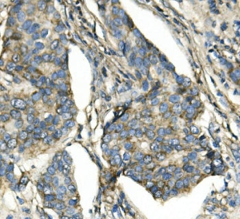 IHC staining of FFPE human breast cancer with ATP5H antibody. HIER: boil tissue sections in pH8 EDTA