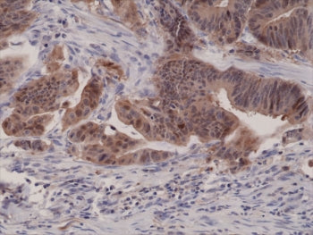 IHC testing of FFPE human colon cancer tissue with recombinant p16INK4a antibody at 1:1000.