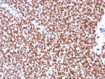 IHC testing of Ewing's sarcoma stained with recombinant NKX2.2 antibody (clone rNX2/294). Required H