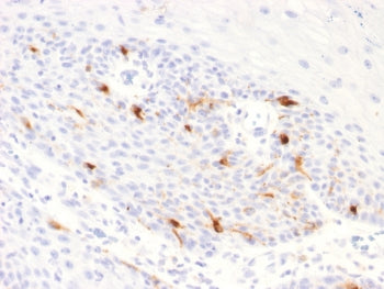 IHC testing of FFPE human basal cell carcinoma with recombinant TRP1 antibody (clone TYPR1/2340R). R