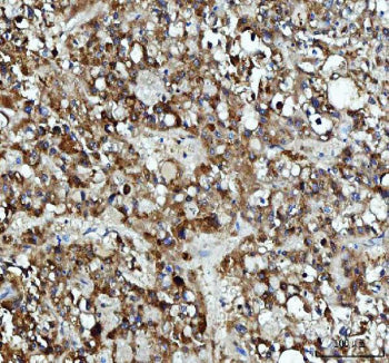 Immunohistochemical staining of DCTPP1 using anti-DCTPP1 antibody. DCTPP1 was detected in a paraffin