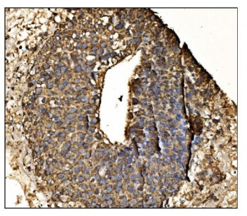 IHC staining of FFPE human liver cancer tissue with Antizyme inhibitor 2 antibody. HIER: boil tissue sections in pH8 EDTA for 20 min and allow to cool before testing.
