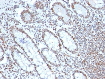 IHC testing of FFPE human colon carcinoma with BMI-1 antibody (clone BMI1/2689). HIER: boil tissue s