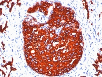 IHC: Formalin-fixed, paraffin-embedded human breast carcinoma stained with pan Cytokeratin antibody 