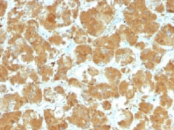 IHC testing of FFPE human thyroid carcinoma with TSHR antibody (clone TSHRA/1402). Required HIER: bo