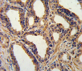 IHC testing of FFPE human prostate carcinoma tissue with NPPA antibody. HIER: steam section in pH6 c