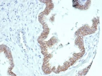 IHC staining of FFPE human prostate carcinoma tissue with recombinant Beta Catenin antibody (clone C