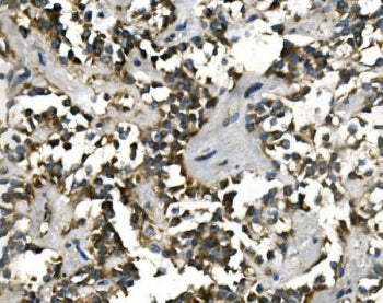 IHC staining of FFPE human pancreatic cancer with VMAT1 antibody. HIER: boil tissue sections in pH8 
