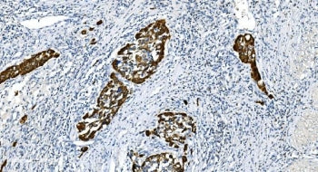 IHC staining of FFPE human bladder cancer with Glycine decarboxylase antibody. HIER: boil tissue sec