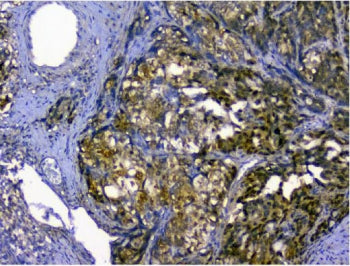 IHC staining of FFPE human stomach cancer with p62 antibody. HIER: boil tissue sections in pH8 EDTA 