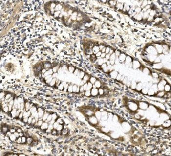 IHC staining of FFPE human rectal cancer with ACO1 antibody. HIER: boil tissue sections in pH8 EDTA 